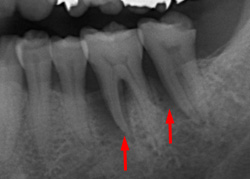 左下臼歯部の骨再生治療