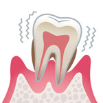 歯周病の進行度